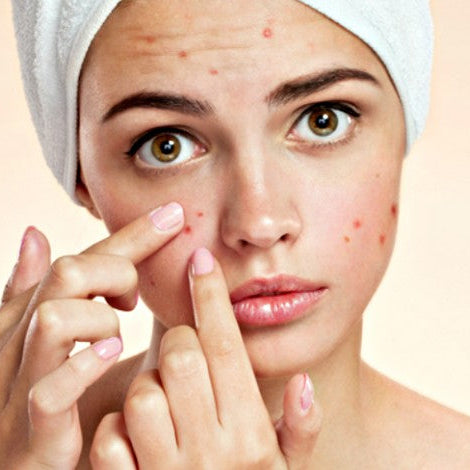 COMBO AVENE ACNÉ JUVENIL